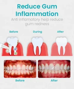 NESLEMY™ Gum Shield Therapy Gel