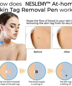 NESLEMY™ At-home Skin Tag Removal Pen