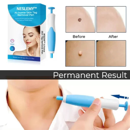 NESLEMY™ At-home Skin Tag Removal Pen