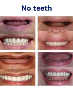 NESLEMY®-🦷Advanced Customized Full Denture Set