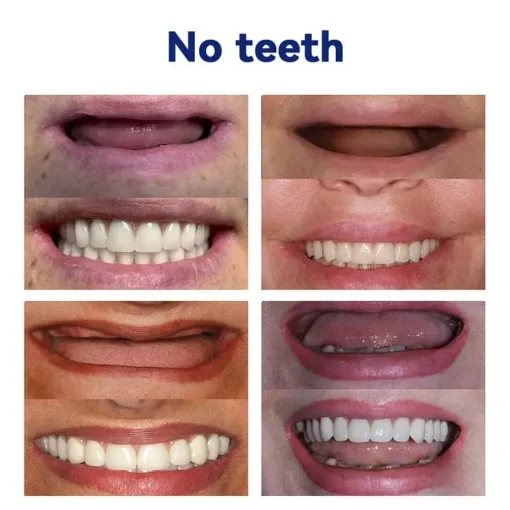 NESLEMY®-🦷Advanced Customized Full Denture Set