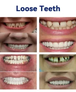 NESLEMY®-🦷Advanced Customized Full Denture Set