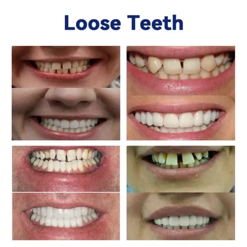NESLEMY®-🦷Advanced Customized Full Denture Set