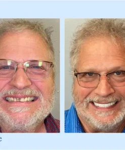 NESLEMY™ - Advanced Customized Full Denture Set