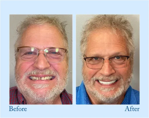 NESLEMY™ - Advanced Customized Full Denture Set