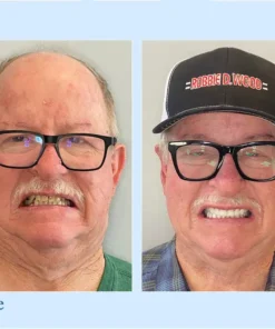 NESLEMY™ - Advanced Customized Full Denture Set