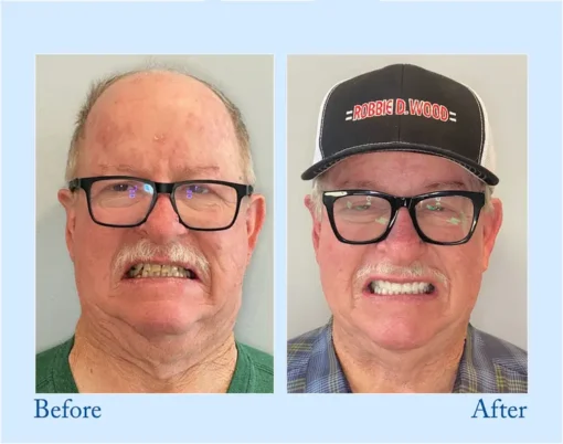 NESLEMY™ - Advanced Customized Full Denture Set