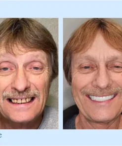 NESLEMY™ - Advanced Customized Full Denture Set