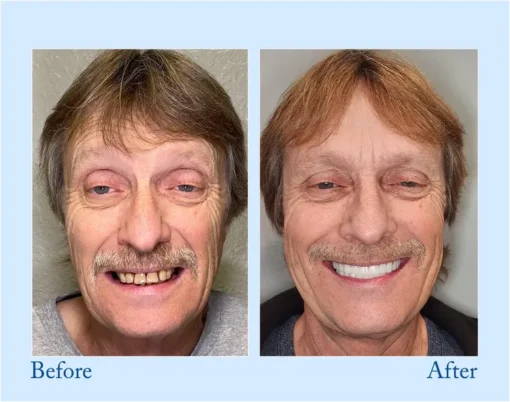 NESLEMY™ - Advanced Customized Full Denture Set