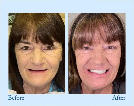 NESLEMY™ - Advanced Customized Full Denture Set