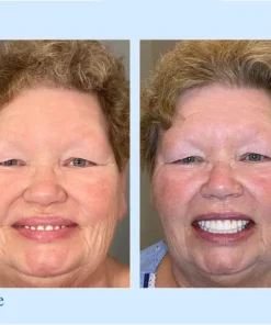 NESLEMY™ - Advanced Customized Full Denture Set