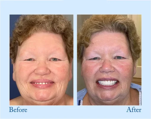 NESLEMY™ - Advanced Customized Full Denture Set