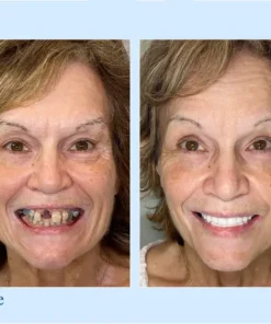 NESLEMY™ - Advanced Customized Full Denture Set
