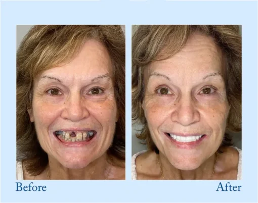 NESLEMY™ - Advanced Customized Full Denture Set