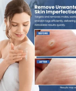 NESLEMY™ ClearWarts Instant Blemish Removal Cream