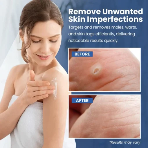 NESLEMY™ ClearWarts Instant Blemish Removal Cream