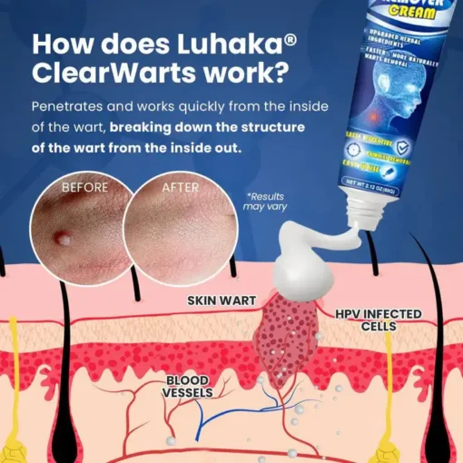 NESLEMY™ ClearWarts Instant Blemish Removal Cream