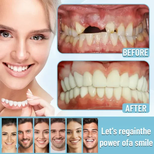 【NESLEMY® Official Store】🦷Advanced Full Denture Set ⏳Limited-Time 30-Minute Discount!⏳