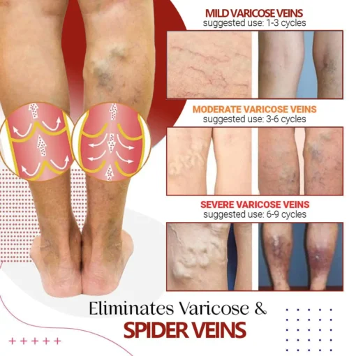 NESLEMY™Varicose Vein Relief Cream