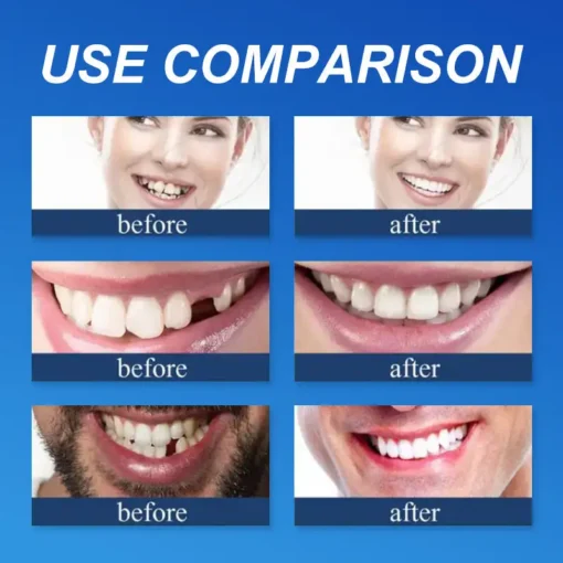 NESLEMY™ --Advanced Customized Full Denture Set