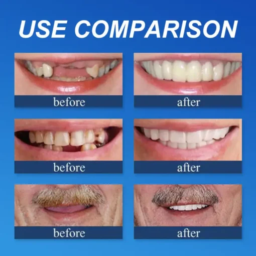 NESLEMY™ --Advanced Customized Full Denture Set