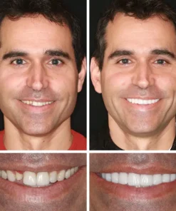 NESLEMY™ --Advanced Customized Full Denture Set