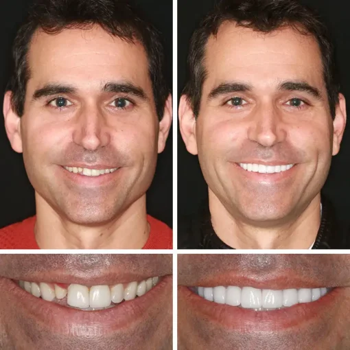 NESLEMY™ --Advanced Customized Full Denture Set