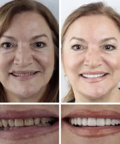 NESLEMY™ --Advanced Customized Full Denture Set