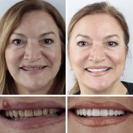 NESLEMY™ --Advanced Customized Full Denture Set