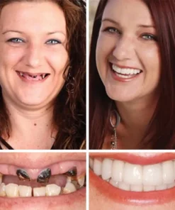 NESLEMY™ --Advanced Customized Full Denture Set
