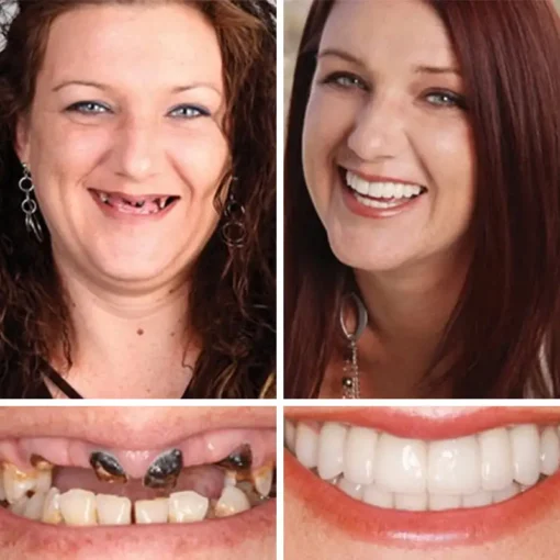 NESLEMY™ --Advanced Customized Full Denture Set
