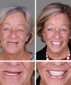 NESLEMY™ --Advanced Customized Full Denture Set