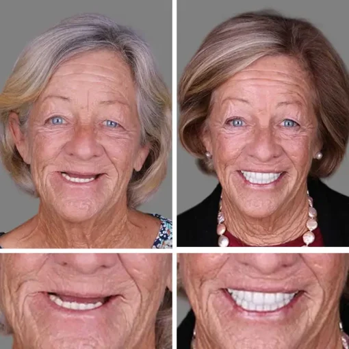 NESLEMY™ --Advanced Customized Full Denture Set