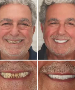 NESLEMY™ Advanced Customized Full Denture Set
