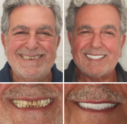 NESLEMY™ Advanced Customized Full Denture Set