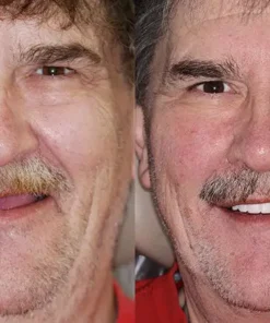 NESLEMY™ Advanced Customized Full Denture Set