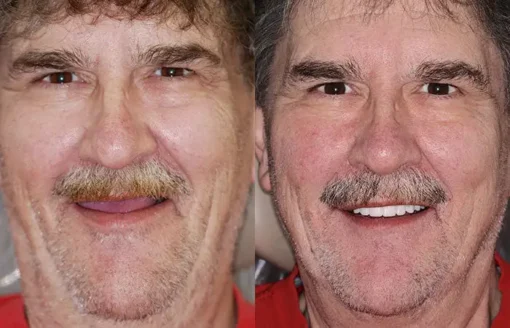 NESLEMY™ Advanced Customized Full Denture Set