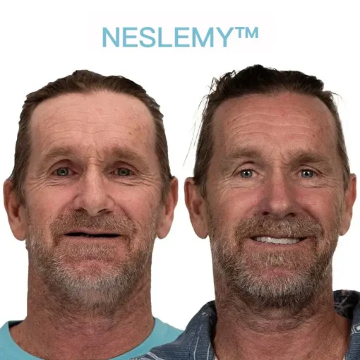 NESLEMY™ GelFit Dentures
