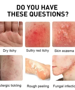 NESLEMY™ Psoriasis Cure Cream