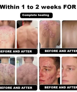 NESLEMY™ Psoriasis Cure Cream