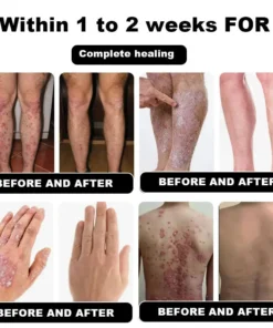 NESLEMY™ Psoriasis Cure Cream