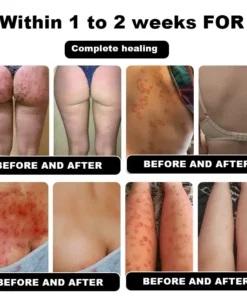 NESLEMY™ Psoriasis Cure Cream