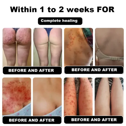 NESLEMY™ Psoriasis Cure Cream