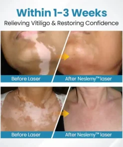 Neslemy™ DermaBeam Vitiligo Therapy Device