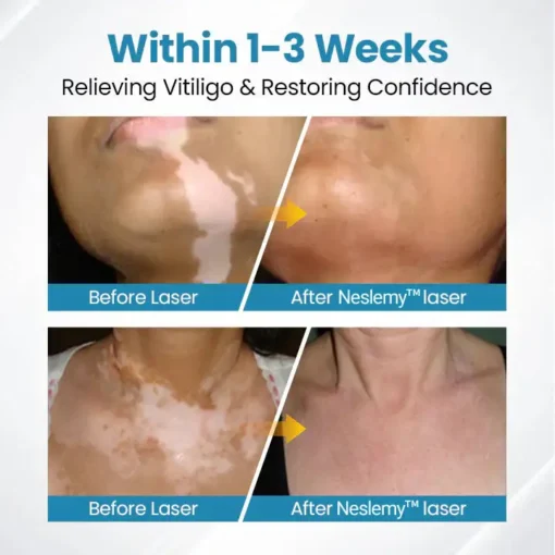 Neslemy™ DermaBeam Vitiligo Therapy Device