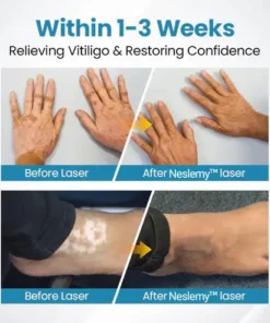 Neslemy™ DermaBeam Vitiligo Therapy Device