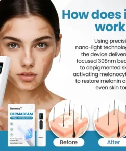 Neslemy™ DermaBeam Vitiligo Therapy Device