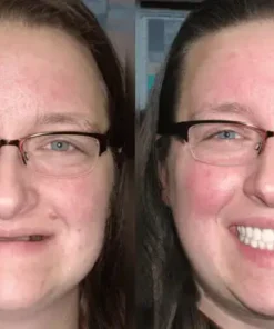 NESLEMY™ Advanced Custom Dentures
