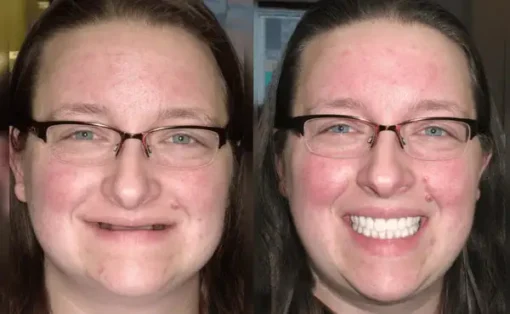 NESLEMY™ Advanced Custom Dentures