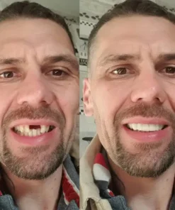 NESLEMY® BioFusion Dentures
